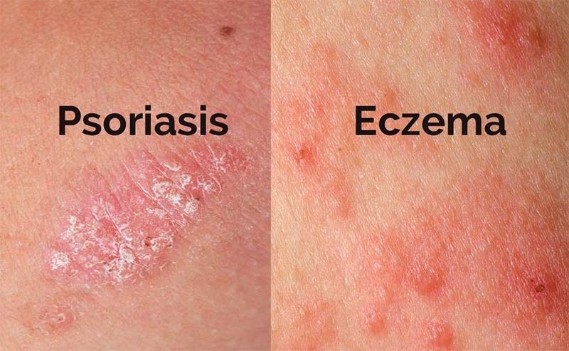 Whats the difference between psoriasis and eczema - Eczema Association ...