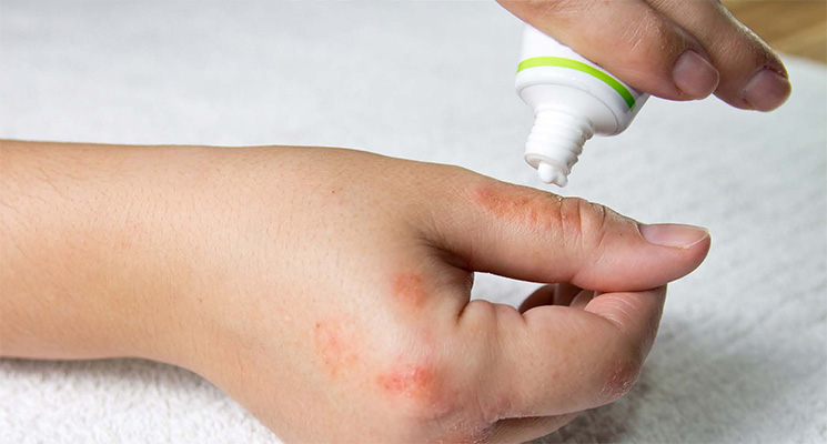 Corticosteroid Creams and Eczema